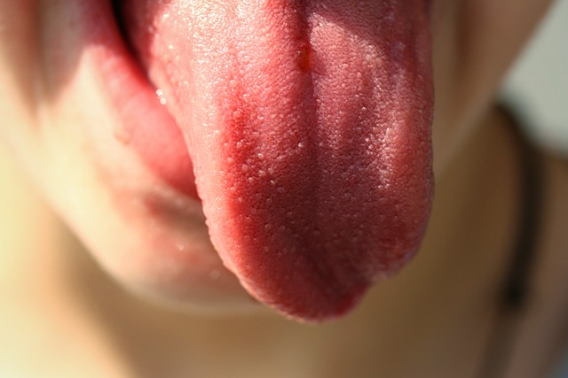 Fissured Tongue with White Dry Coating